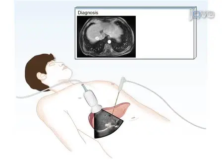 Thermal Ablation for the Treatment of Abdominal Tumors