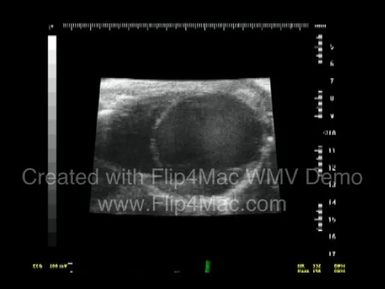 The Application Of Permanent Middle Cerebral Artery Ligation in the Mouse