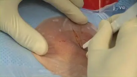 A New Single Chamber Implantable Defibrillator with Atrial Sensing: A Practical Demonstration of Sensing and  Ease of Implantation