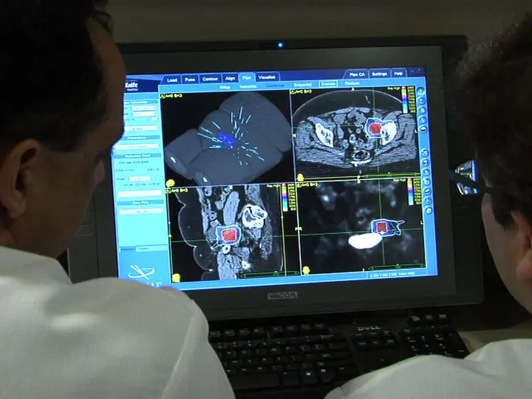 Stereotactic Radiosurgery for Gynecologic Cancer