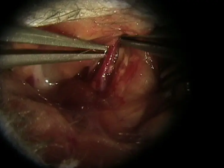 Mouse Model of Intraluminal MCAO: Cerebral Infarct Evaluation by Cresyl Violet Staining