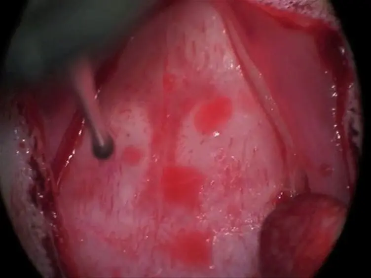 Endothelin-1 Induced Middle Cerebral Artery Occlusion Model for Ischemic Stroke with Laser Doppler Flowmetry Guidance in Rat