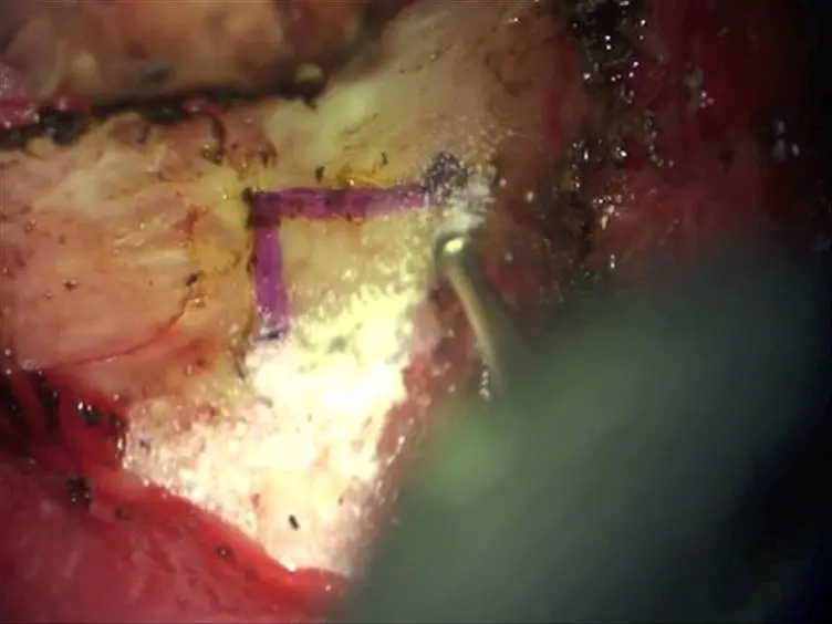 Utilizing a Cranial Window to Visualize the Middle Cerebral Artery During Endothelin-1 Induced Middle Cerebral Artery Occlusion