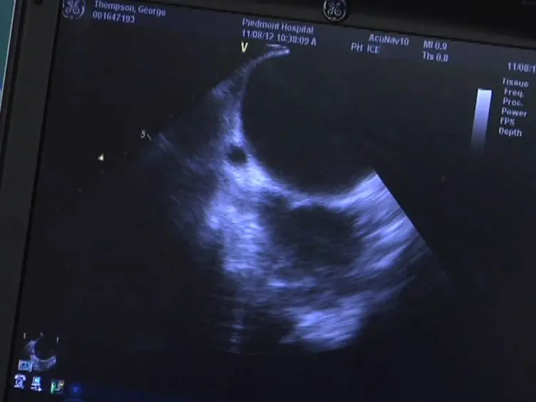 Direct Pressure Monitoring Accurately Predicts Pulmonary Vein Occlusion During Cryoballoon Ablation
