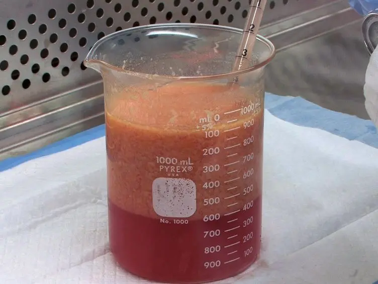 Manual Isolation of Adipose-derived Stem Cells from Human Lipoaspirates