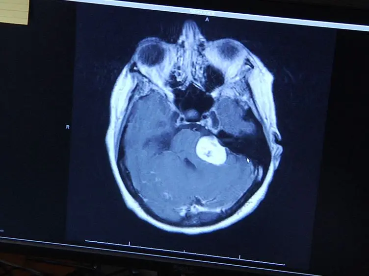 Primary Culture of Human Vestibular Schwannomas