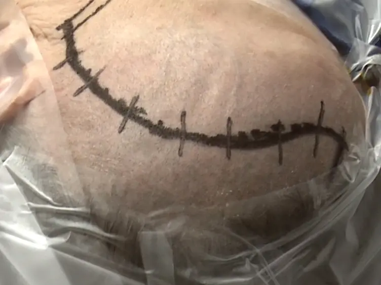 Minimally Invasive Thumb-sized Pterional Craniotomy for Surgical Clip Ligation of Unruptured Anterior Circulation Aneurysms