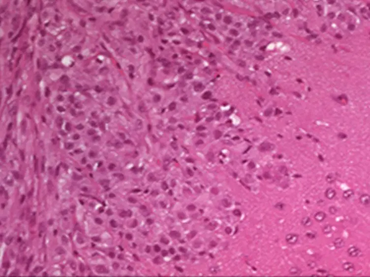 Creating Anatomically Accurate and Reproducible Intracranial Xenografts of Human Brain Tumors