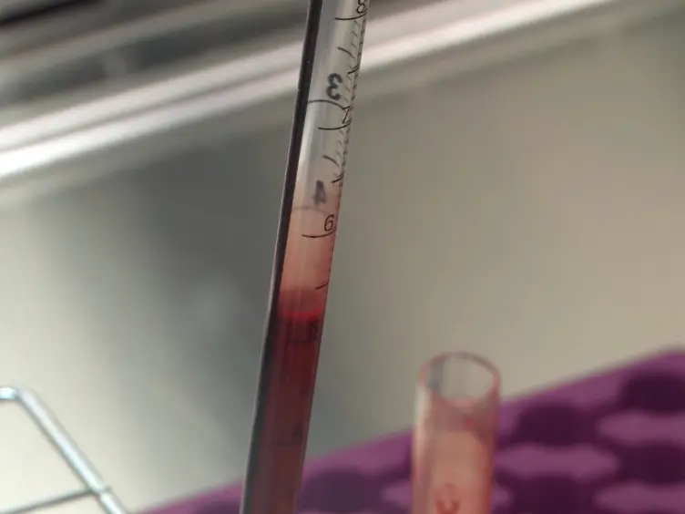 Detecting Glycogen in Peripheral Blood Mononuclear Cells with Periodic Acid Schiff Staining