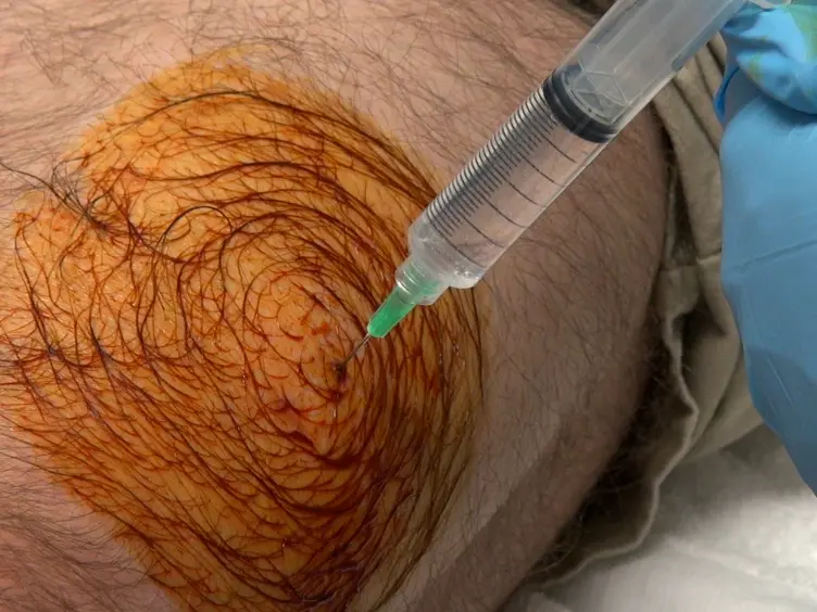 Preparation and Respirometric Assessment of Mitochondria Isolated from Skeletal Muscle Tissue Obtained by Percutaneous Needle Biopsy