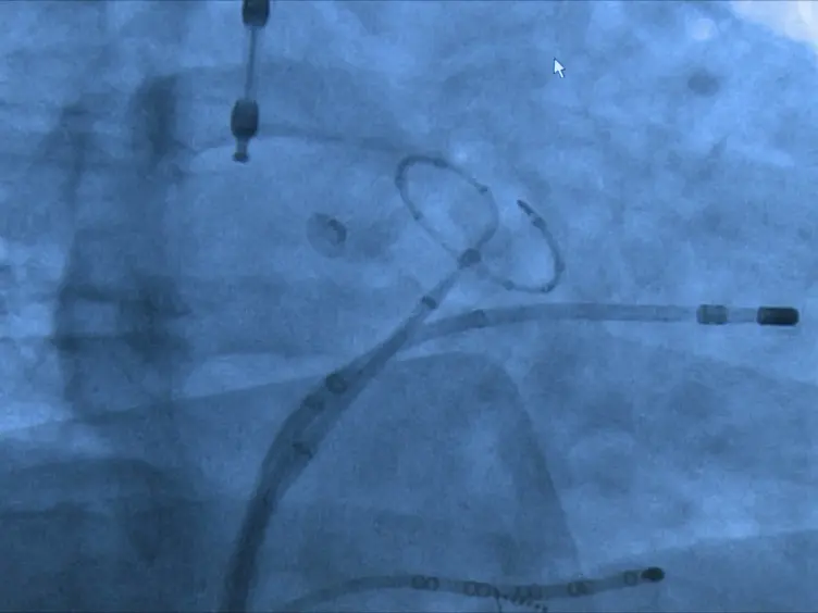 Robotic Ablation of Atrial Fibrillation