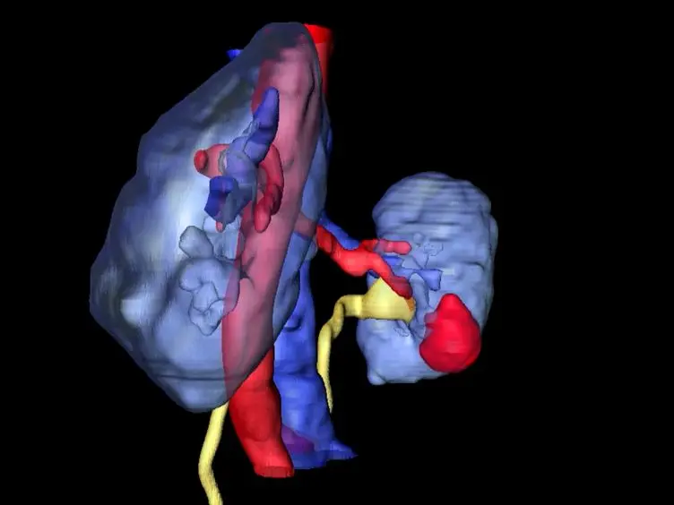 <em>In Vivo</em>, Percutaneous, Needle Based, Optical Coherence Tomography of Renal Masses