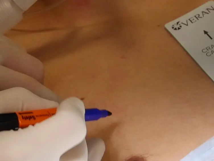 Use of Electromagnetic Navigational Transthoracic Needle Aspiration (E-TTNA) for Sampling of Lung Nodules