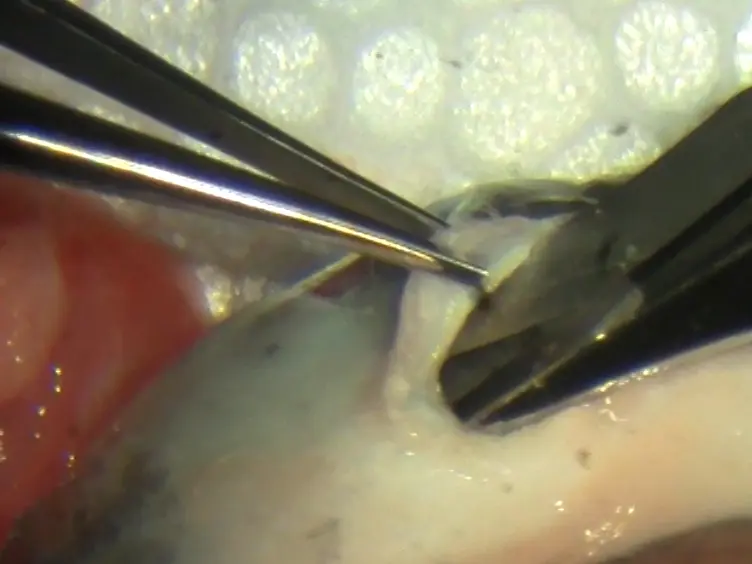 Whole Vitreous Humor Dissection for Vitreodynamic Analysis