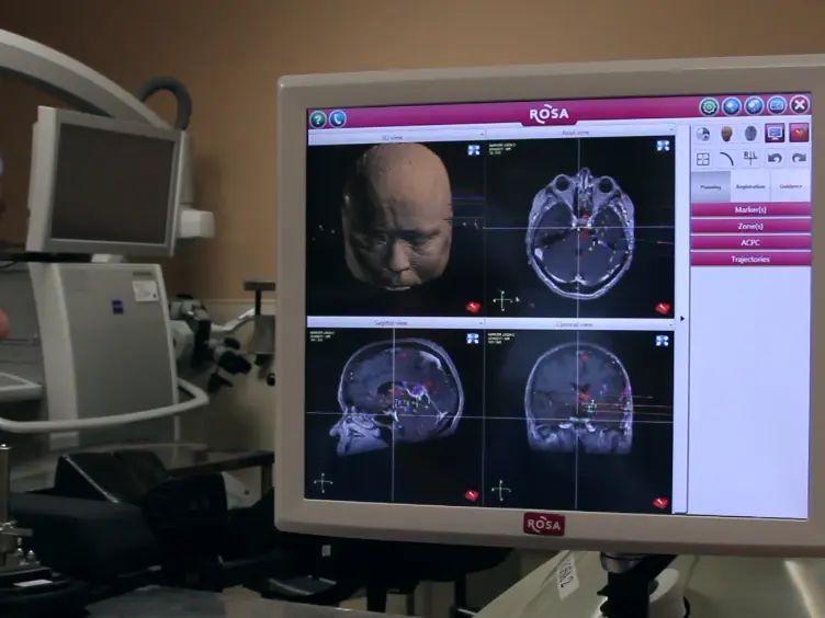 Stereo-Electro-Encephalo-Graphy (SEEG) With Robotic Assistance in the Presurgical Evaluation of Medical Refractory Epilepsy: A Technical Note