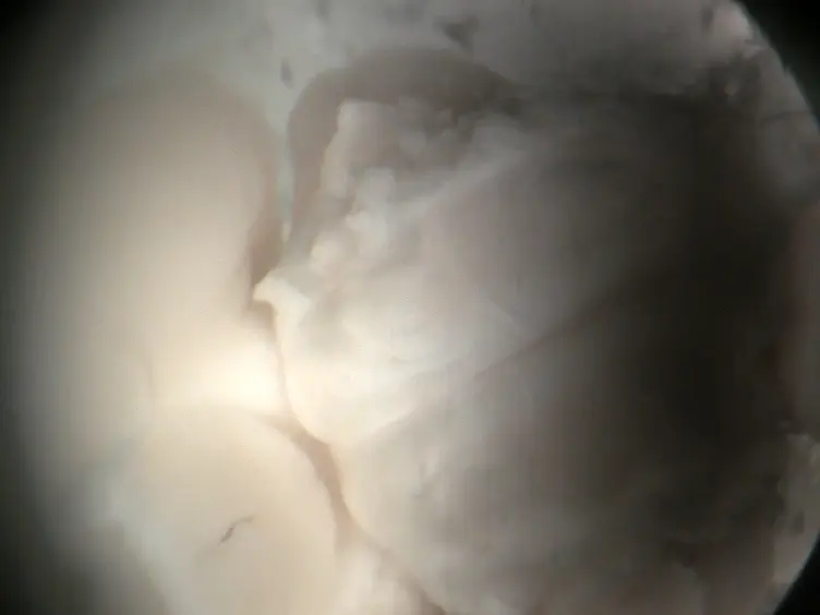 Laser-guided Neuronal Tracing In Brain Explants