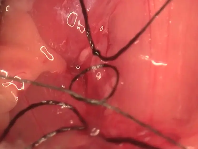Surgical Approach for Middle Cerebral Artery Occlusion and Reperfusion Induced Stroke in Mice