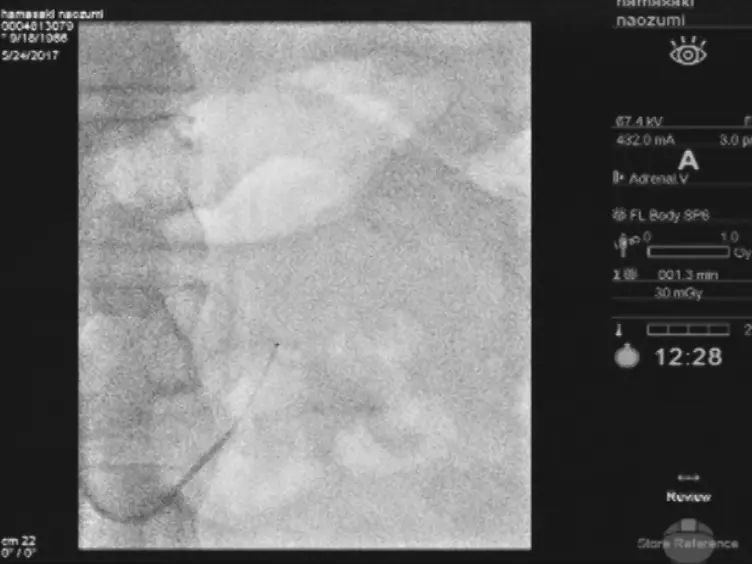 A Novel Method: Super-selective Adrenal Venous Sampling