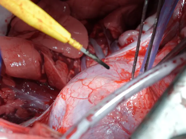 Use of Two Intracorporeal Ventricular Assist Devices As a Total Artificial Heart