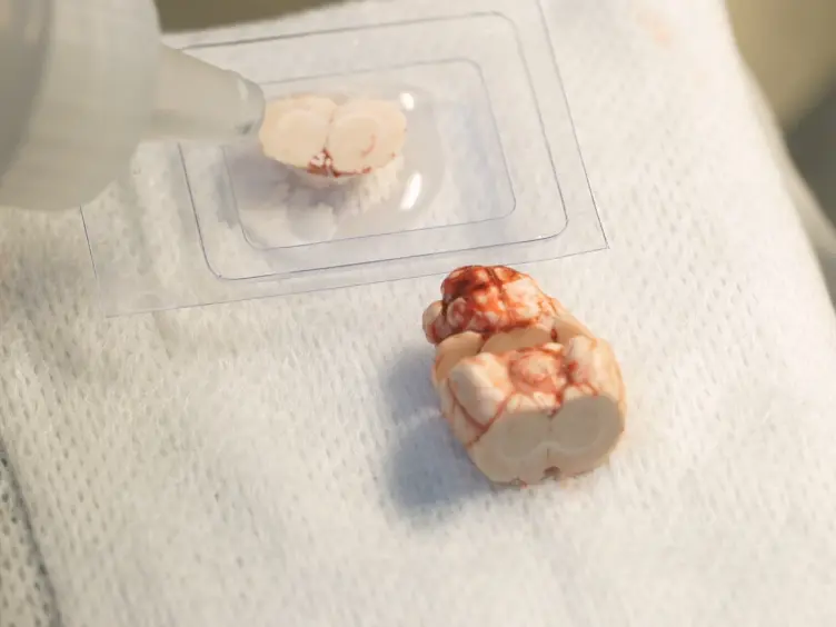 Stereotactic Atlas-Guided Laser Capture Microdissection of Brain Regions Affected by Traumatic Injury