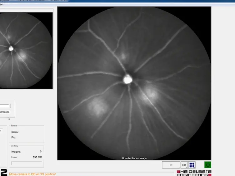 <em>In Vivo</em> Multimodal Imaging and Analysis of Mouse Laser-Induced Choroidal Neovascularization Model