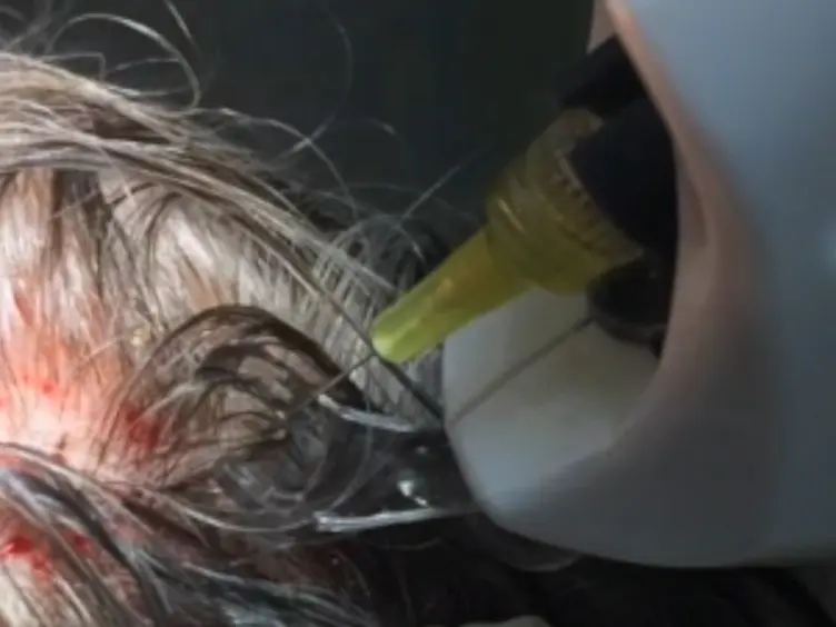 Mechanical and Controlled PRP Injections in Patients Affected by Androgenetic Alopecia