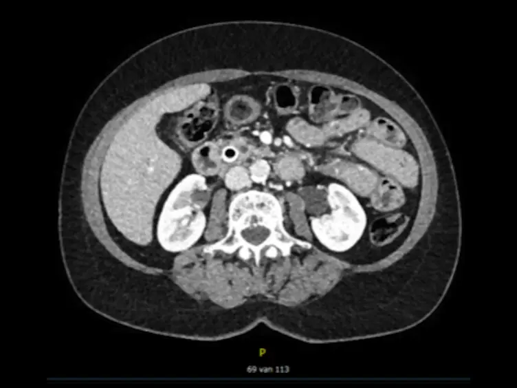 Laparoscopic Pancreatoduodenectomy With Modified Blumgart Pancreaticojejunostomy