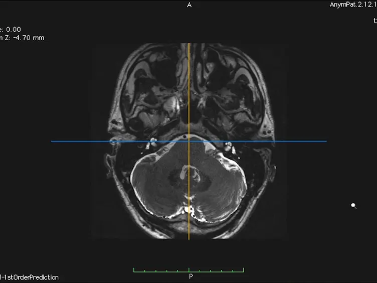 <em>In Vivo</em> Morphometric Analysis of Human Cranial Nerves Using Magnetic Resonance Imaging in Meni&#232;re's Disease Ears and Normal Hearing Ears