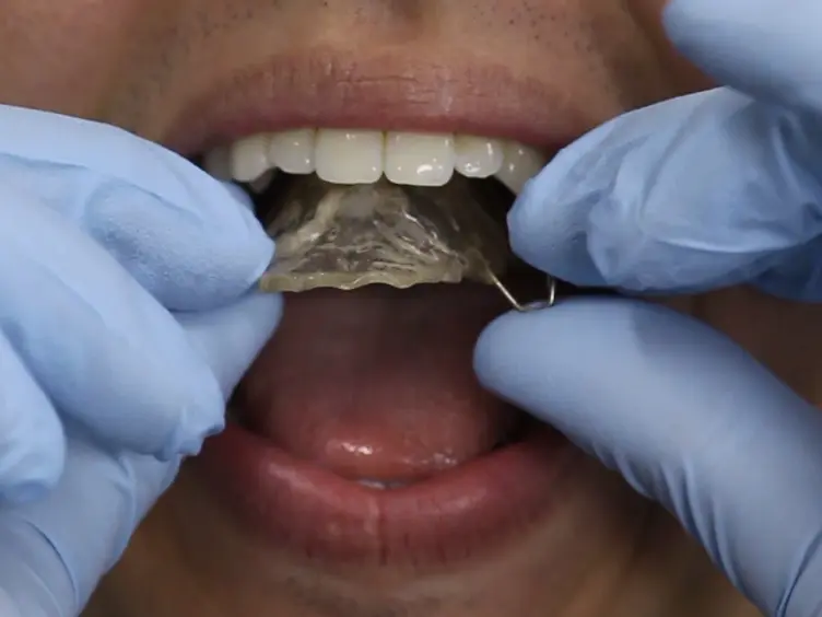 Oral Biofilm Formation on Different Materials for Dental Implants