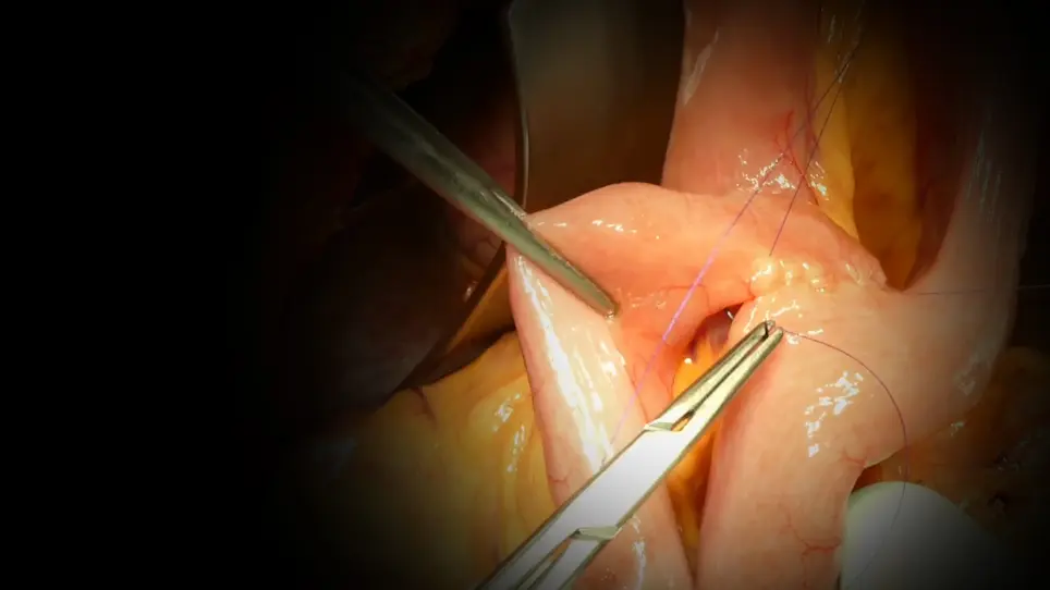 Modified Single-Loop Reconstruction for Pancreaticoduodenectomy