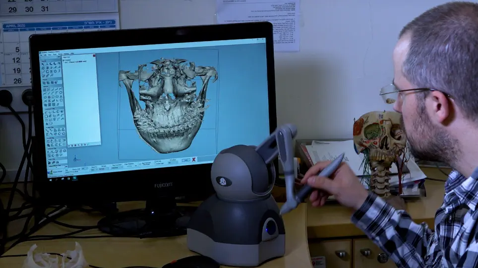 Treatment of Facial Deformities using 3D Planning and Printing of Patient-Specific Implants