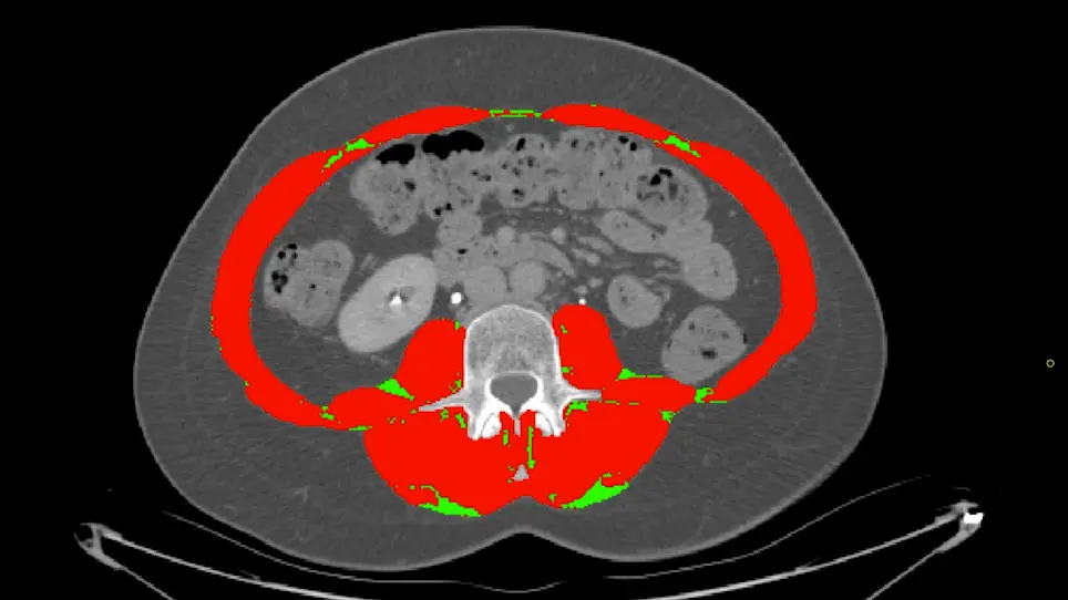 Segmentation and Linear Measurement for Body Composition Analysis using Slice-O-Matic and Horos