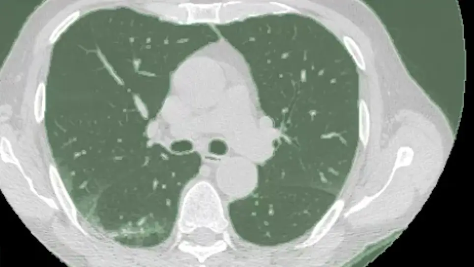 Lung CT Segmentation to Identify Consolidations and Ground Glass Areas for Quantitative Assesment of SARS-CoV Pneumonia