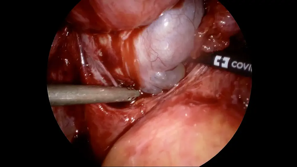 Surgical Techniques to Optimize Ovarian Reserve during Laparoscopic Cystectomy for Ovarian Endometrioma