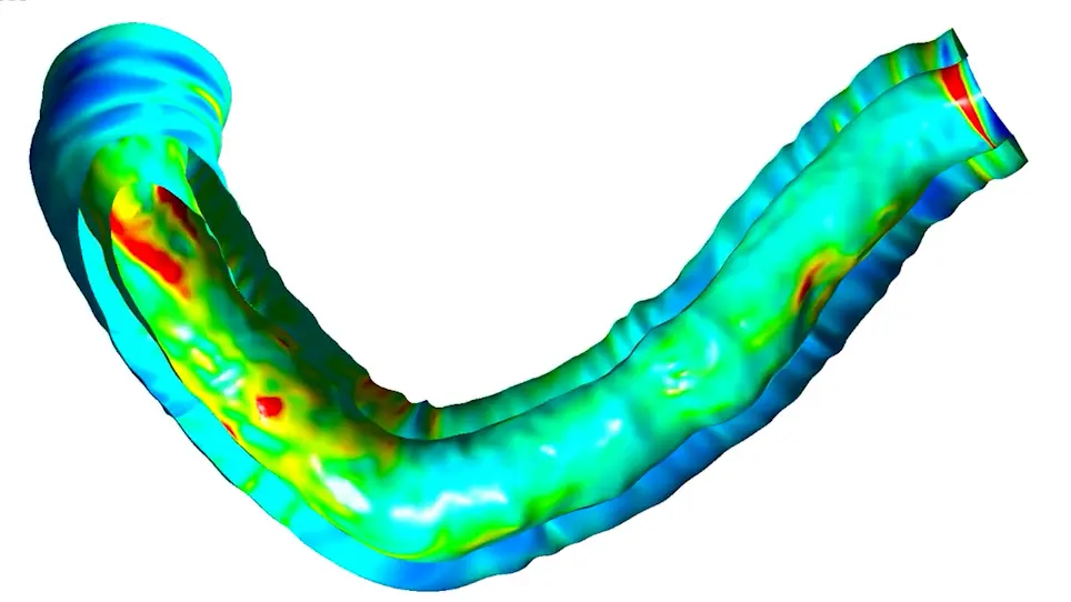 Optical Coherence Tomography Based Biomechanical Fluid-Structure Interaction Analysis of Coronary Atherosclerosis Progression
