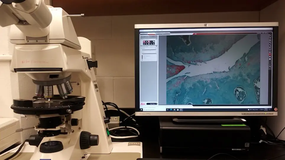 Software-Assisted Quantitative Measurement of Osteoarthritic Subchondral Bone Thickness