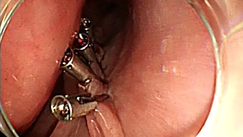 Use of the Scissor-Type Knife During the Peroral Endoscopy Myotomy Procedure for the Treatment of Achalasia