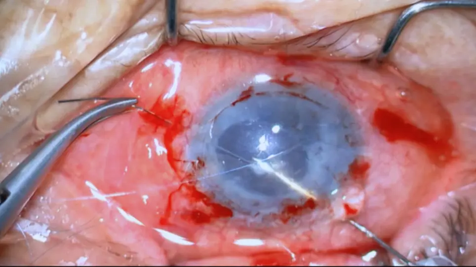 Iris Fixation <em>via</em> External Pentagram Suturing