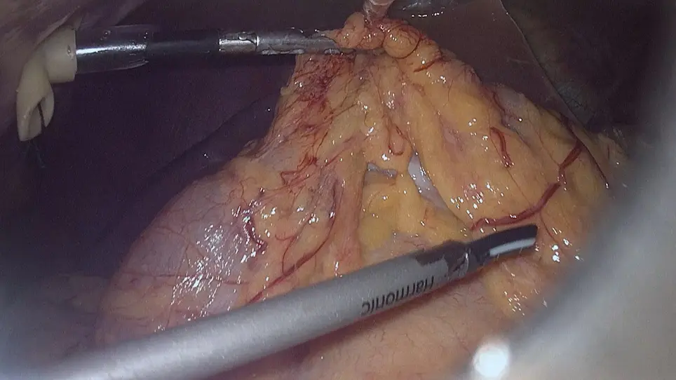 Laparoscopic Pancreatoduodenectomy for Pancreatic Cancer Using <em>In-Situ</em> No-Touch Isolation Technique