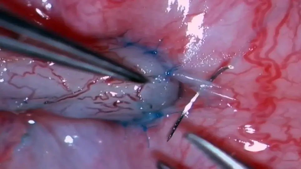 Vessel-Sparing Microsurgical Longitudinal Intussusception Vasoepididymostomy to Treat Epididymal Obstructive Azoospermia