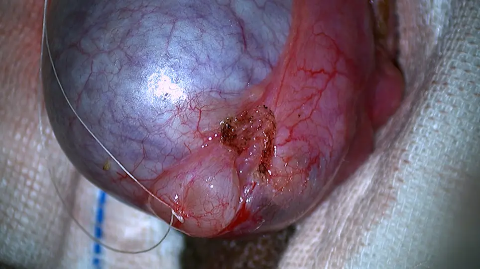 Microscopic Cyst Resection for the Treatment of Patients Diagnosed with Epididymal Cyst
