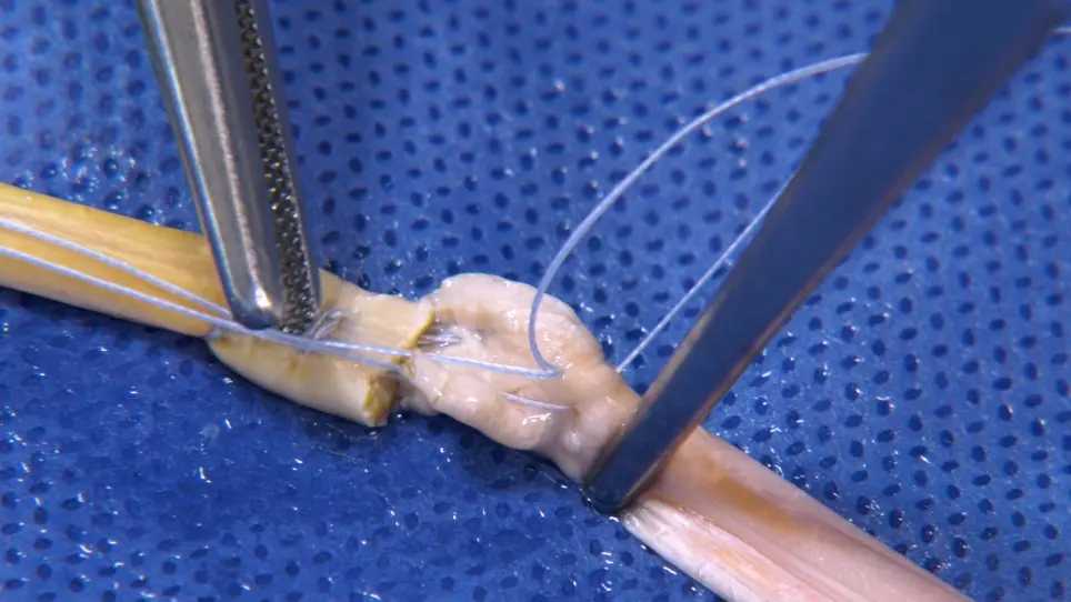 Polytetrafluoroethylene (PTFE) as a Suture Material in Tendon Surgery