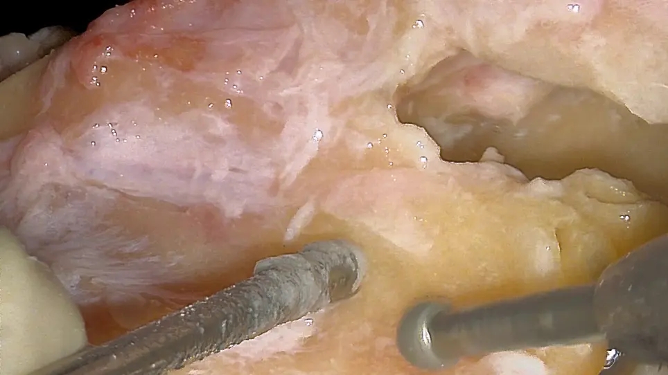 Extracting the Cochlea from a Human Temporal Bone: A Cadaveric Protocol