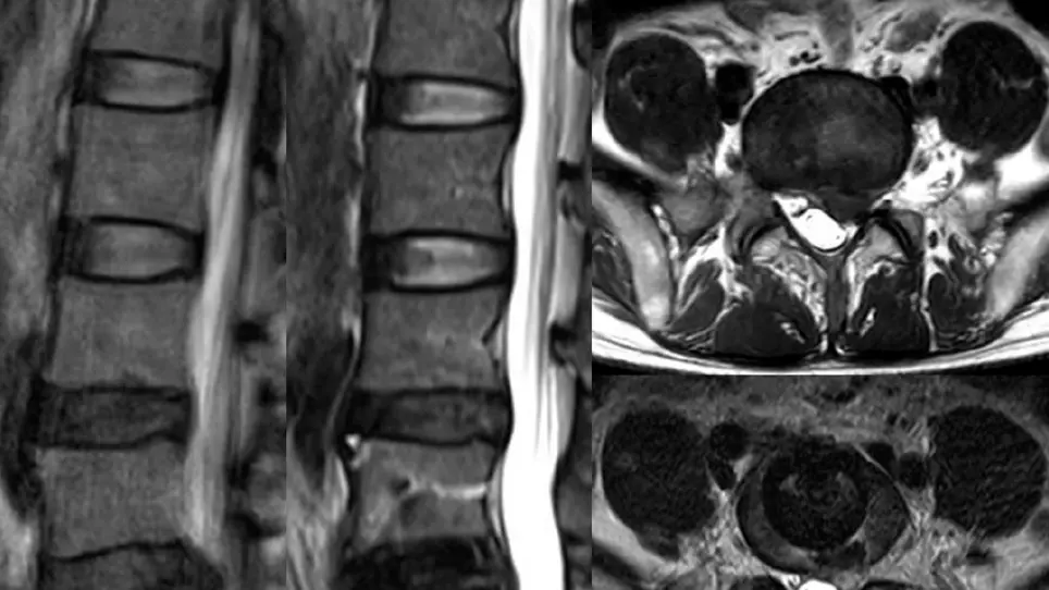 Clinical Application of Microscope-Assisted Minimally Invasive Anterior Lumbar Interbody Fusion