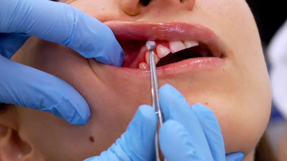 Semi-Automated Planimetric Quantification of Dental Plaque Using an Intraoral Fluorescence Camera