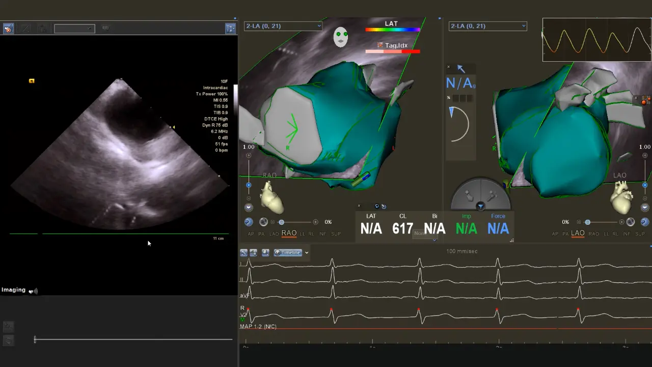 Three-Dimensional Modeling of the Left Atrium and Pulmonary Veins with a Precise Intracardiac Echocardiography Approach