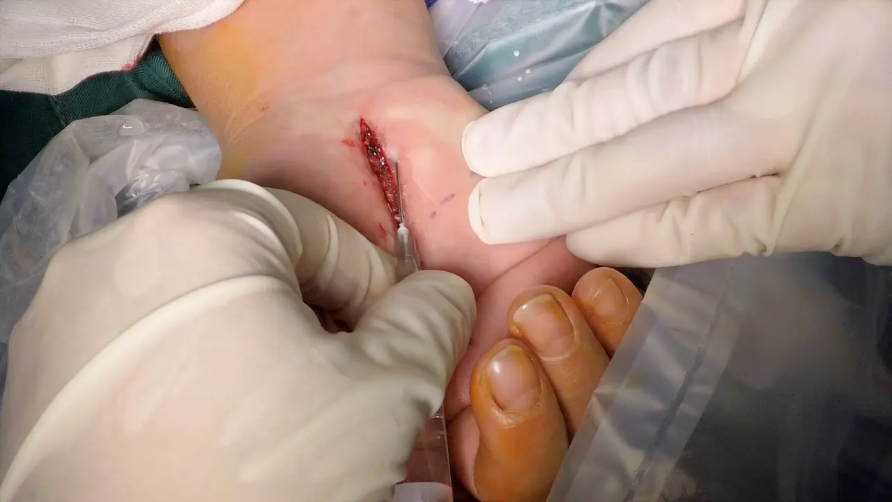 Metacarpal Small Incision for Carpal Tunnel Syndrome