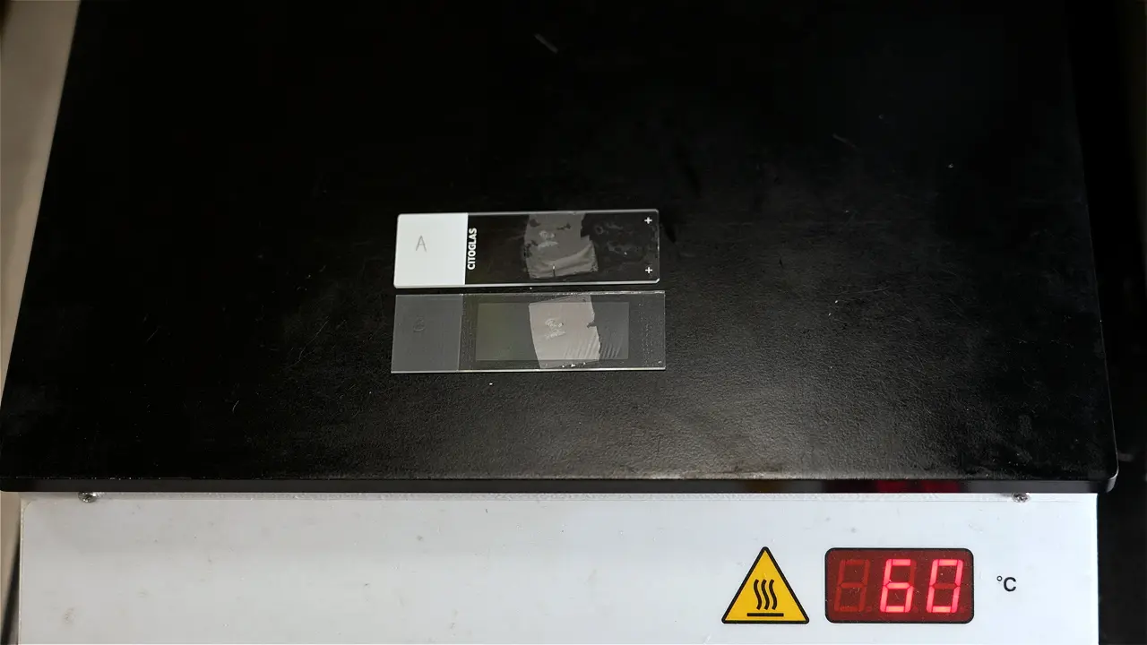 Isolation of Cells with Morphological and Spatial Information from Oral Submucous Fibrosis Samples by Laser Capture Microdissection