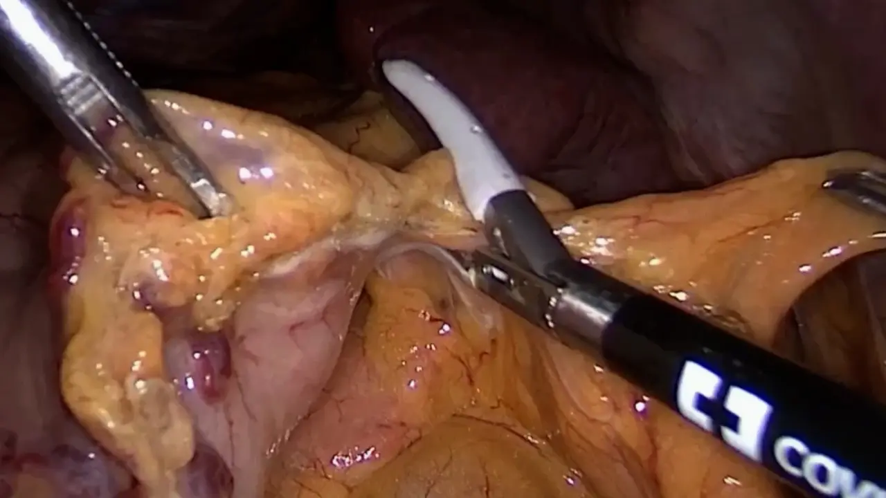 Application of Laparoscopic Partial Splenectomy with Total Blood Flow Occlusion in Benign Splenic Lesions