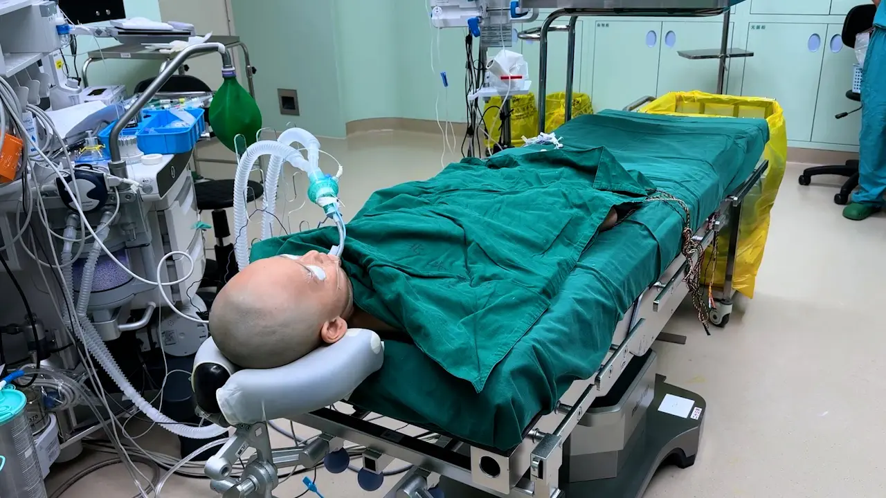 Frontal Disconnection for Treating Mild Malformation of Cortical Development with Oligodendroglial Hyperplasia in Epilepsy (MOGHE) in the Frontal Lobe